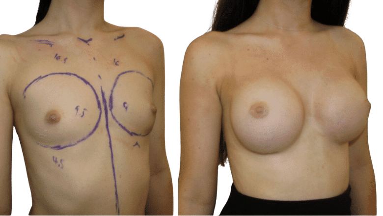 breast surgery before and after case 47 view 2