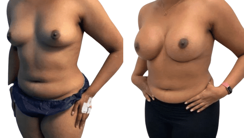 mini boob job before and after London