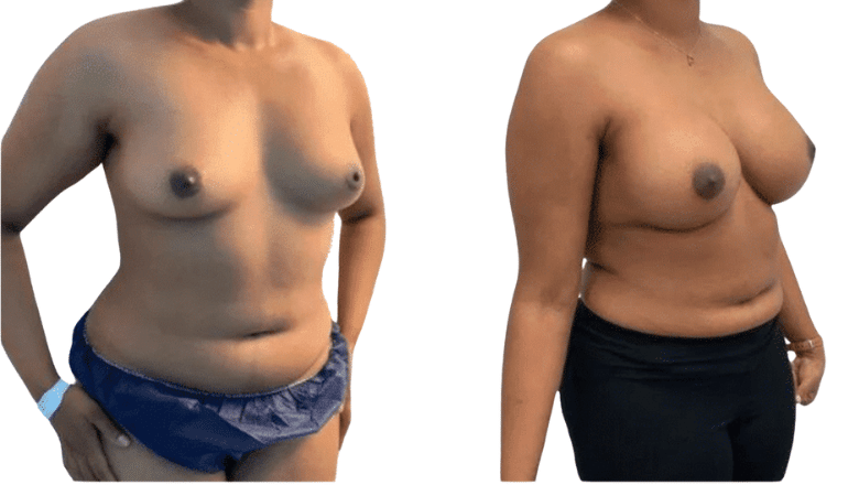 mini breast augmentation before and after case 50 view 2