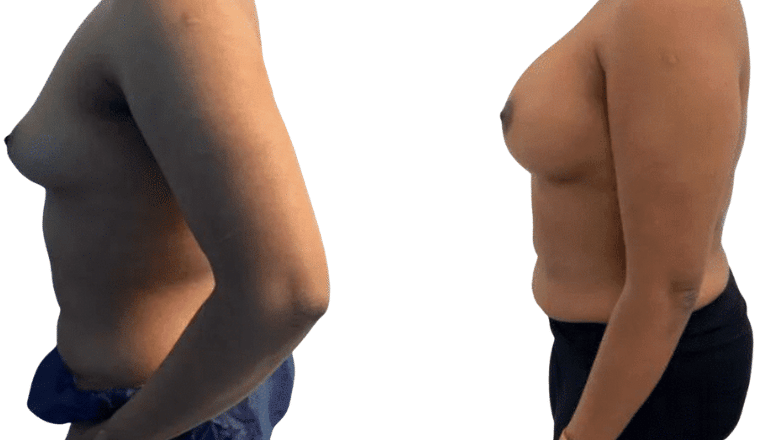 mini breast augmentation before and after case 50 view 3