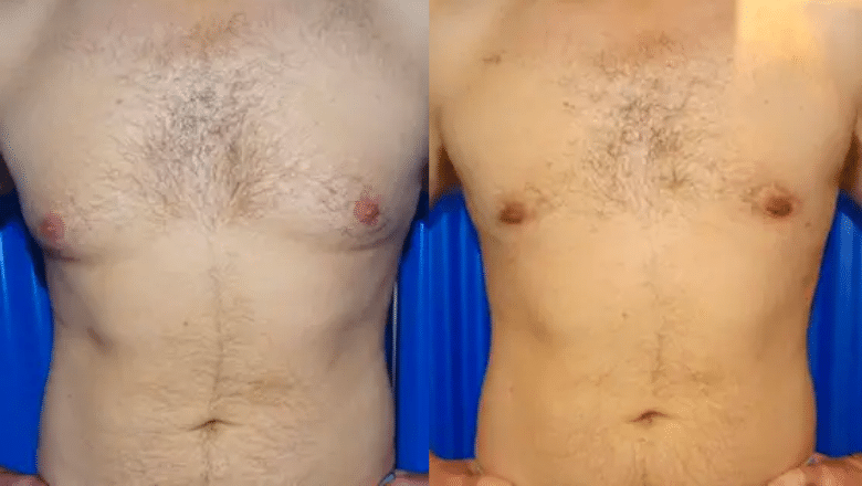 male breast reduction before and after case 1