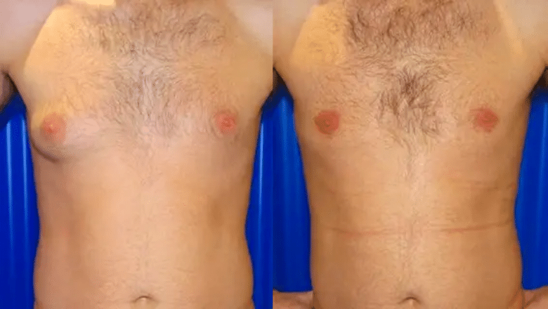 male gyno before and after case 3