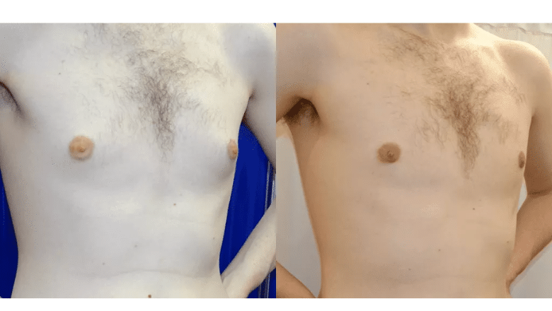gyno surgery before and after case 10