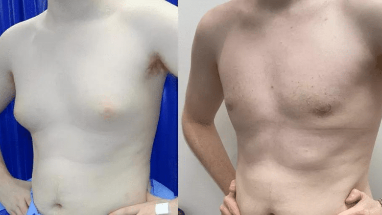 gynecomastia surgery before and after case 12