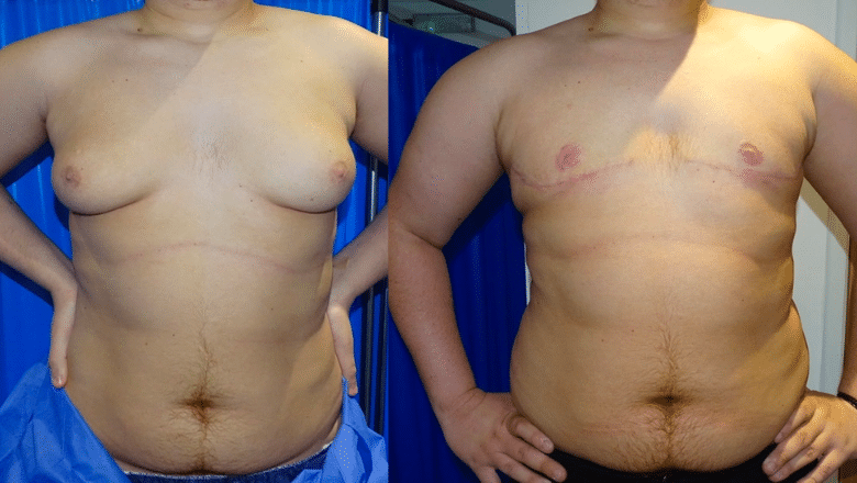 gynecomastia surgery before and after case 11