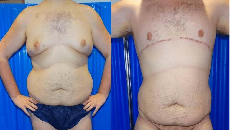 male gyno surgery before and after case 13