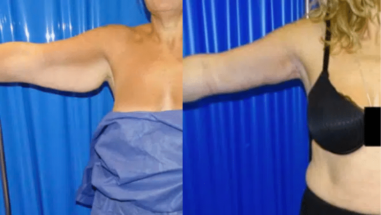 arm lift before and after case 3