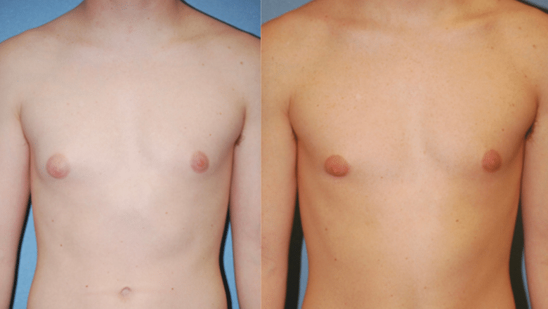 male gyno surgery before and after case 5