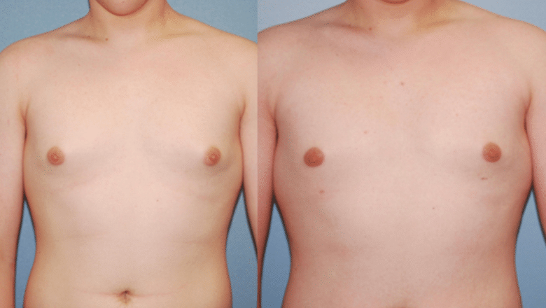 male gyno surgery before and after case 6
