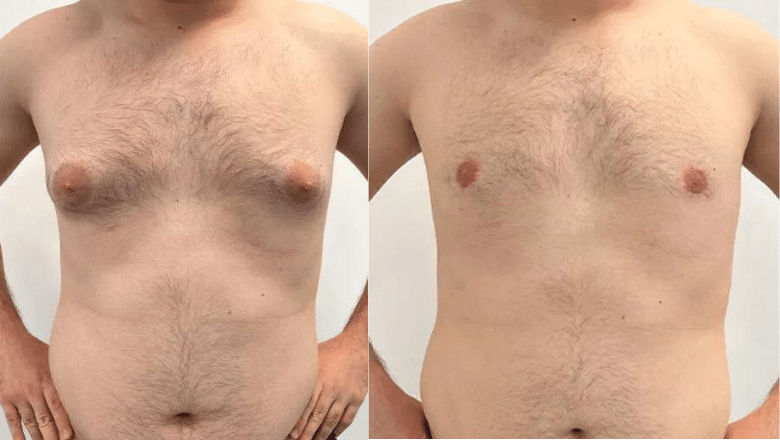 gyno surgery before and after case 15 front view