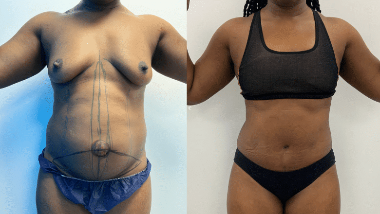 tummy tuck before and after case 2 front view
