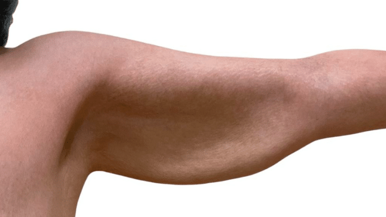 full arm lift before and after case 6