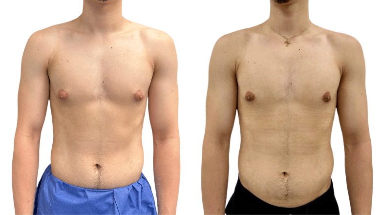 gynecomastia surgery before and after case 2 view 1