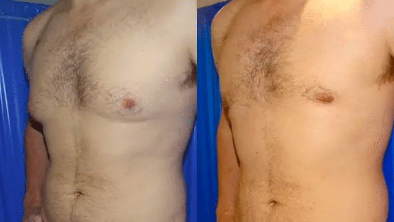male breast reduction before and after case 1 side view
