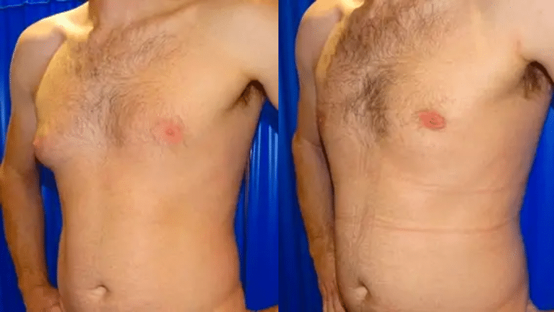 male gyno before and after case 3 view 2
