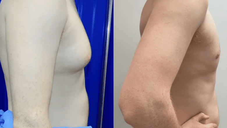 gyno surgery before and after case 10 side view
