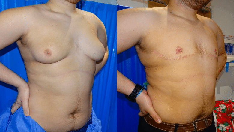 gynecomastia surgery before and after case 11 view 2