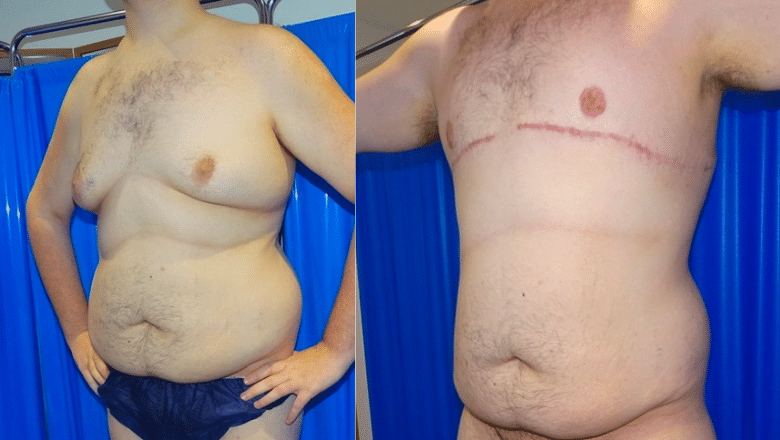 male gyno surgery before and after case 13 side view