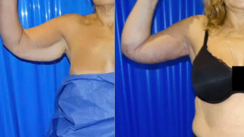 arm lift before and after case 3 side view