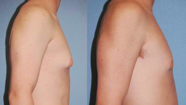 male gyno surgery before and after case 5 side view