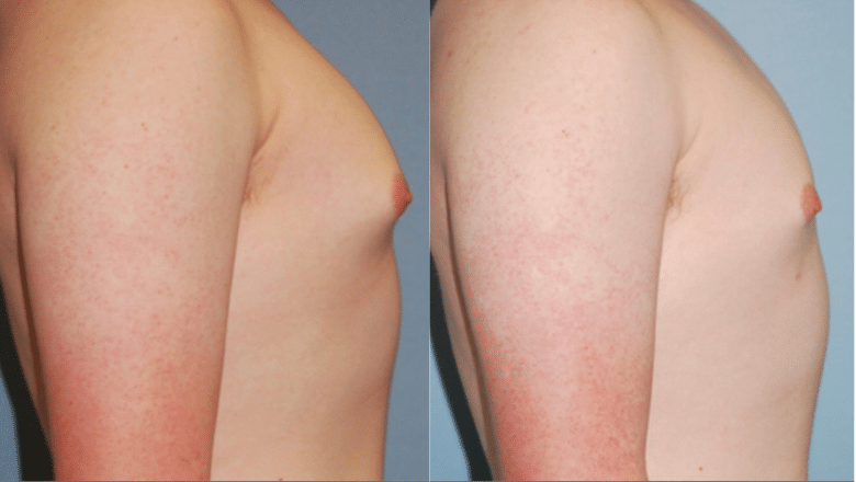 male gyno surgery before and after case 6 side view