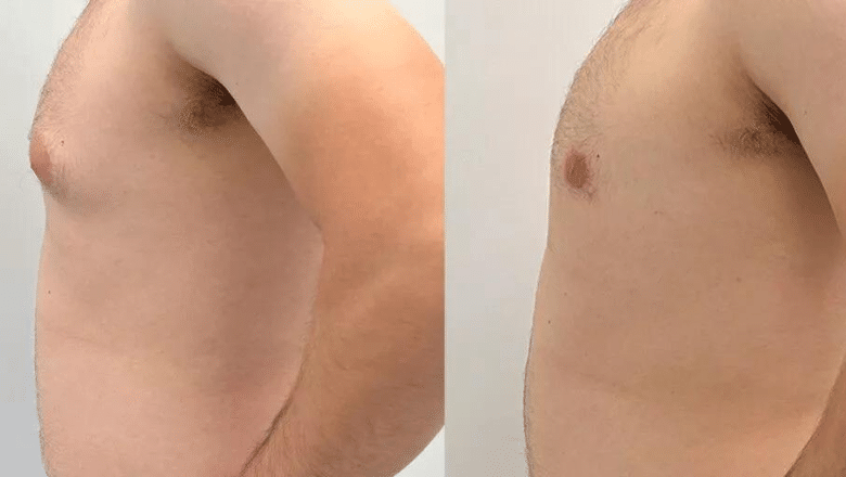 gyno surgery before and after case 15 view 2