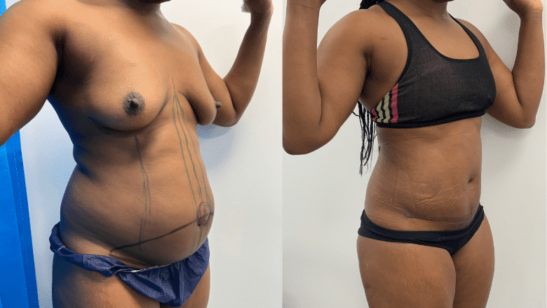 tummy tuck before and after case 2 side view