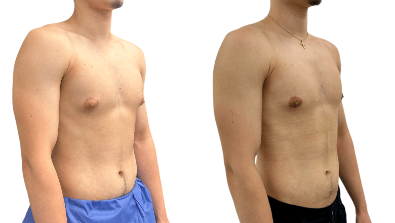 gynecomastia surgery before and after case 2 view 2