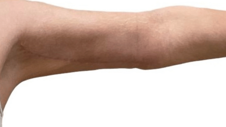 full arm lift before and after case 6 view 2
