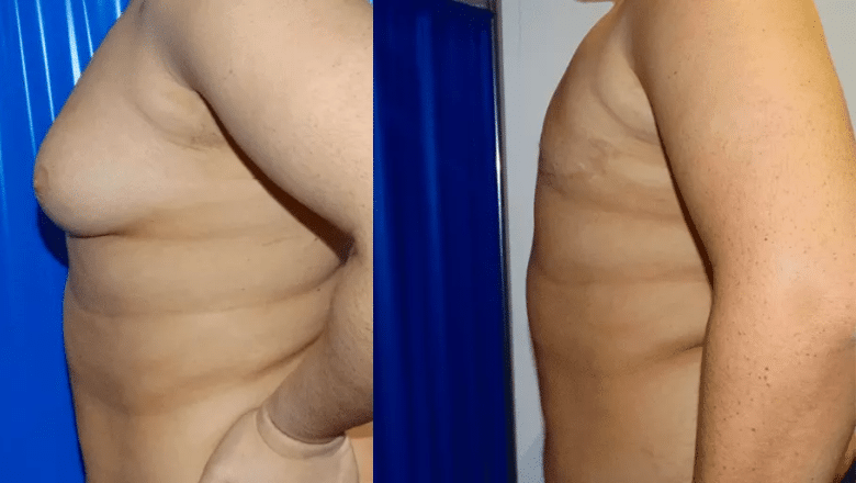 gynecomastia surgery before and after case 11 view 3