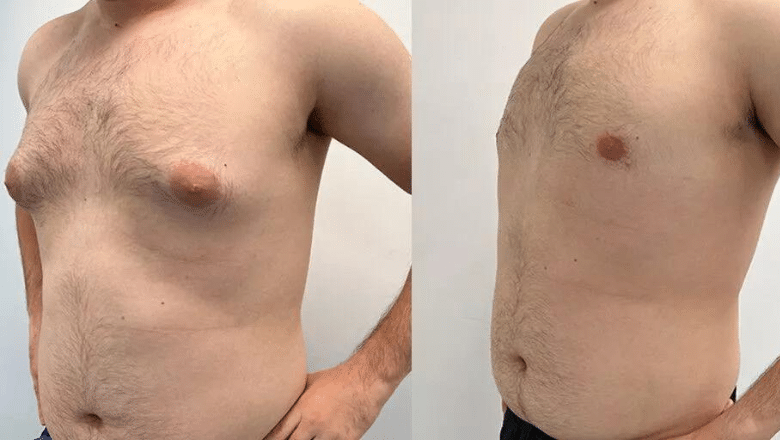 gyno surgery before and after case 15 view 3