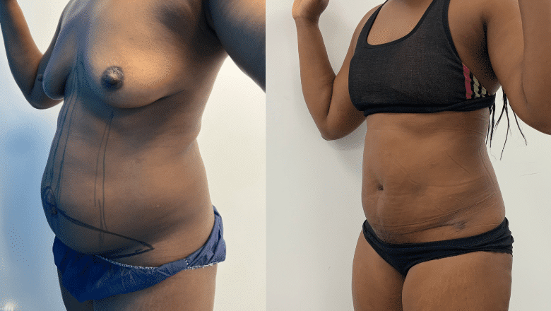 tummy tuck before and after case 2 oblique view