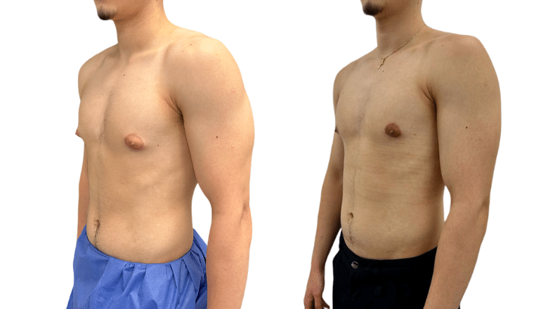 gynecomastia surgery before and after case 2 view 3