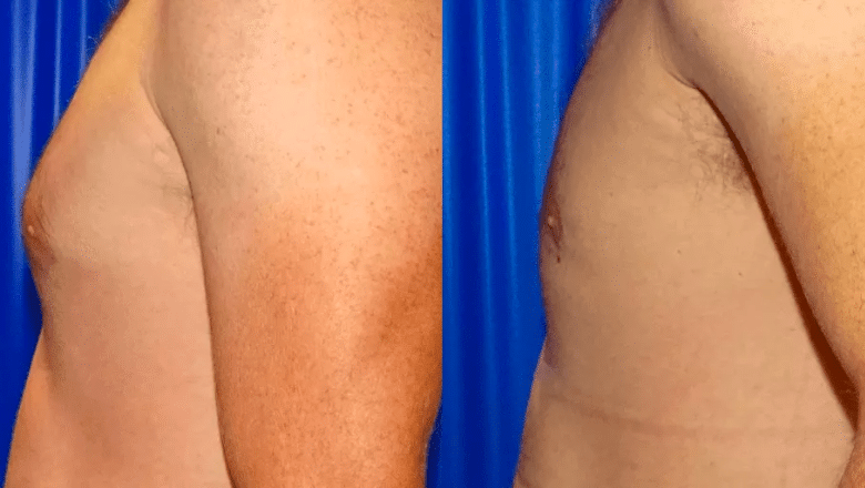 male gyno before and after case 3 view 3