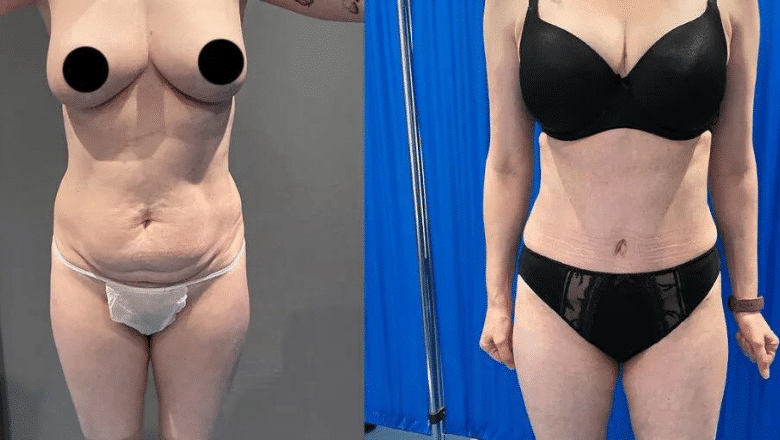 360 lipo and tummy tuck before and after