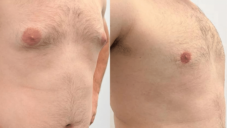 gyno surgery before and after case 15 view 4