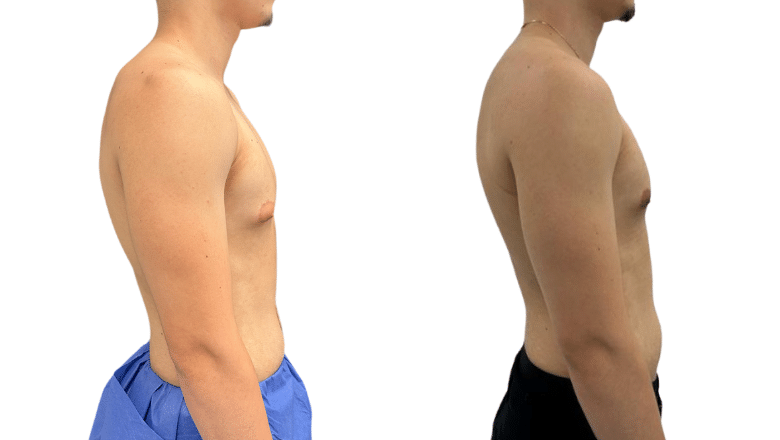 gynecomastia surgery before and after case 2 view 4