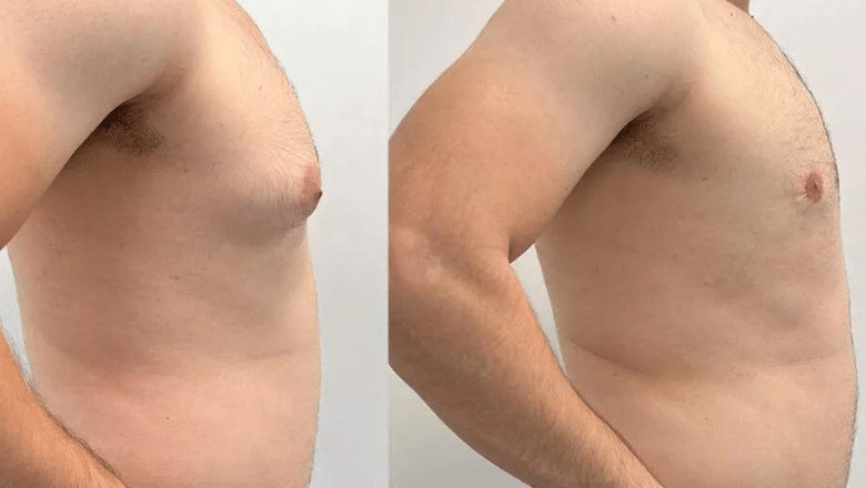 gyno surgery before and after case 15 view 5