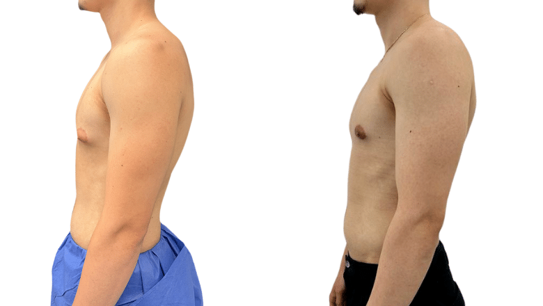gynecomastia surgery before and after case 2 view 5