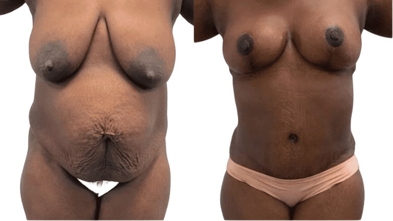 abdominoplasty procedure UK before and after