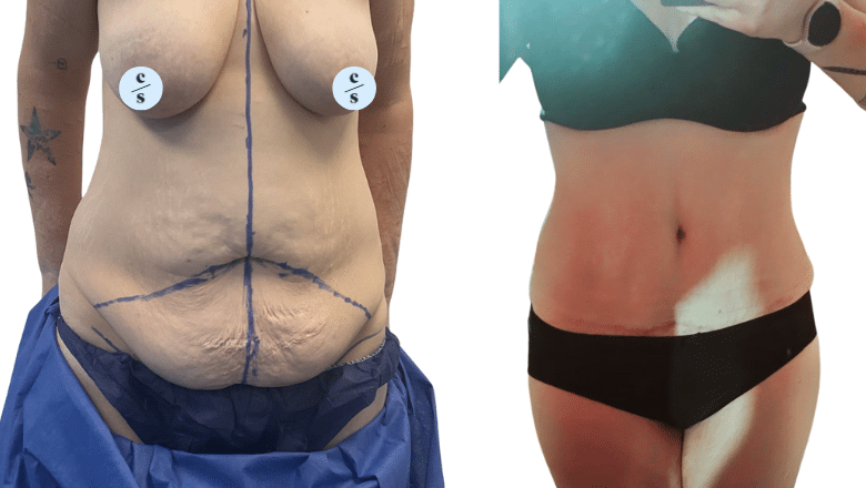 abdominoplasty UK before and after