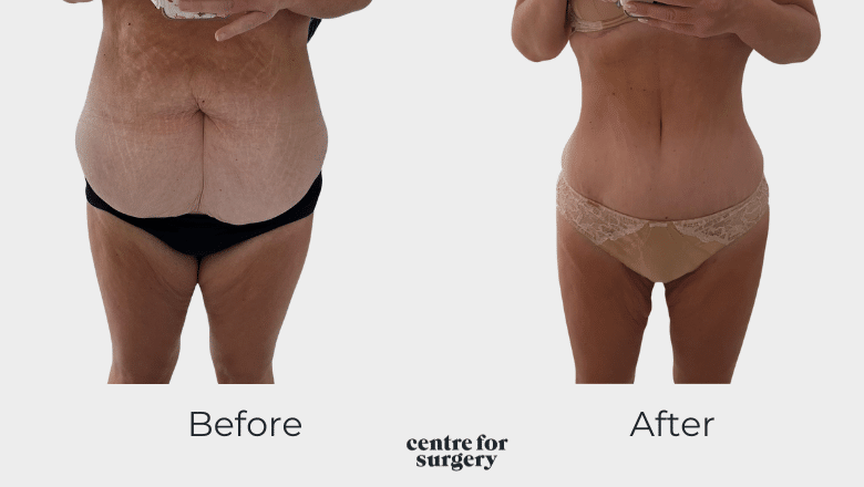 abdominoplasty and muscle repair London UK