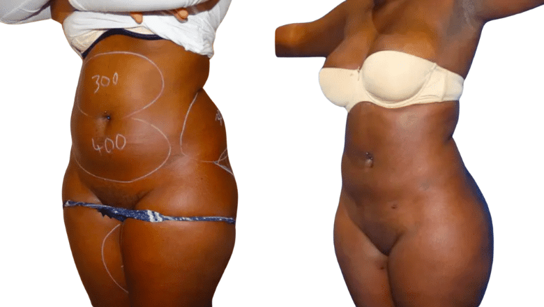 liposuction before and after results London