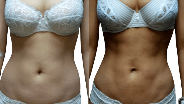 body contouring liposuction before and after London