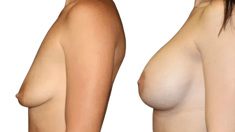 breast reduction before and after case 2