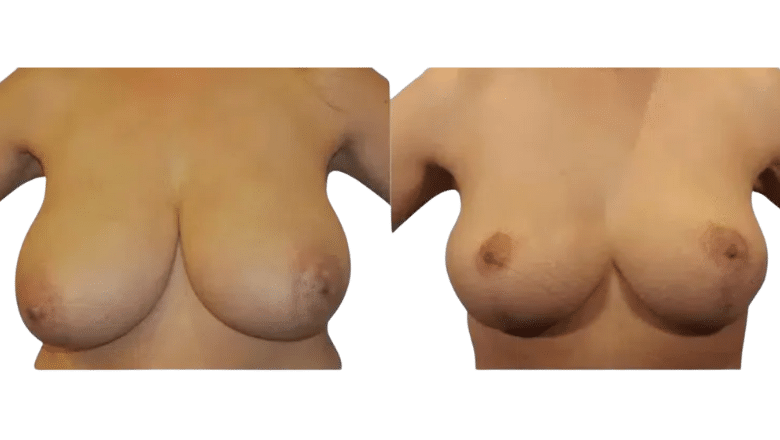 breast reduction before and after case 7