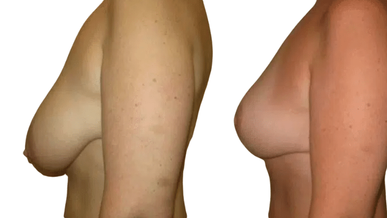 breast reduction before and after case 9