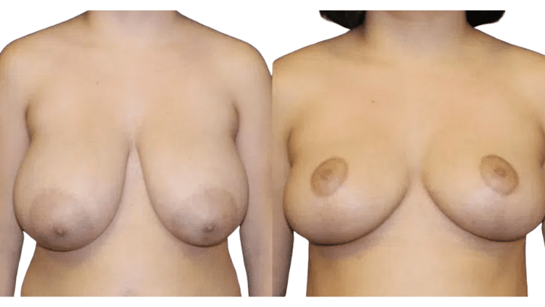 breast reduction before and after case 11