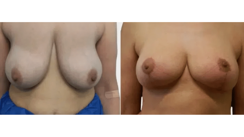 breast reduction before and after case 12