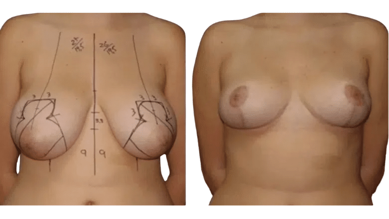 breast reduction before and after case 13